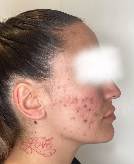 Antes y despues marcas de acne 1