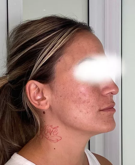 Antes y despues marcas de acne 2