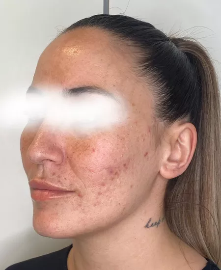 Antes y despues marcas de acne 3