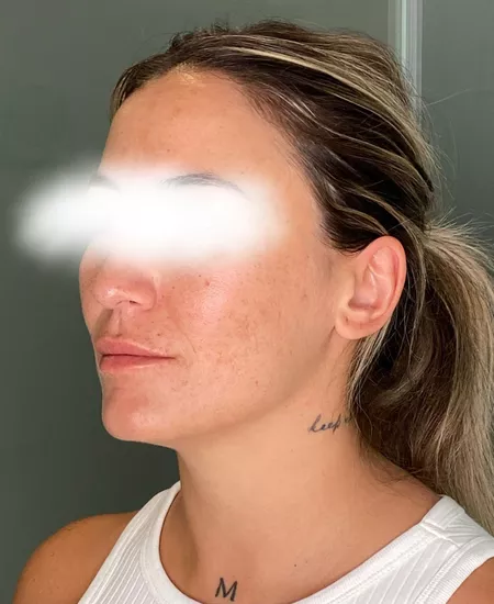 Antes y despues marcas de acne 4