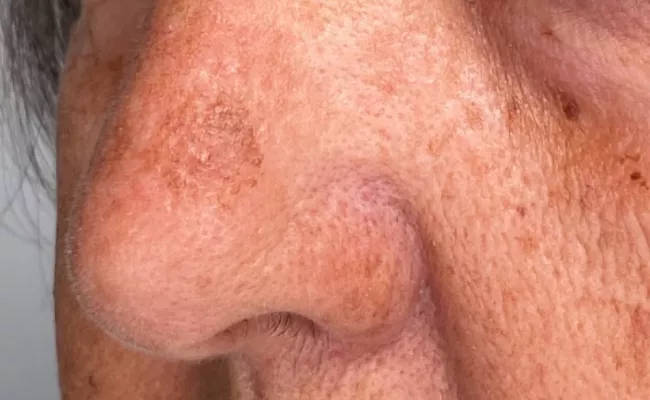 Eliminar manchas antes y despues 1 - Clínica Integral