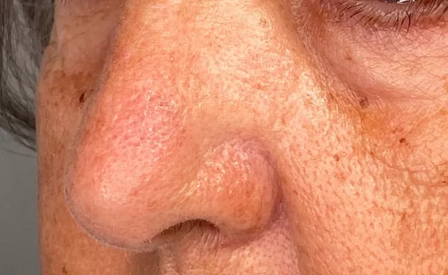 Eliminar manchas antes y despues 2 - Clínica Integral