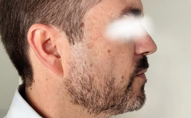 Eliminar manchas antes y despues 3 - Clínica Integral