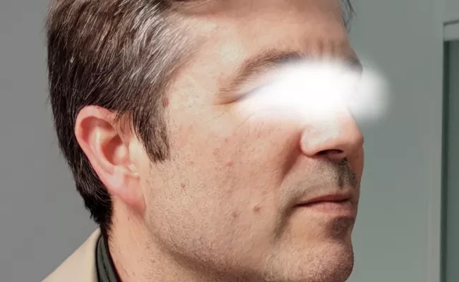 Eliminar manchas antes y despues 4 - Clínica Integral