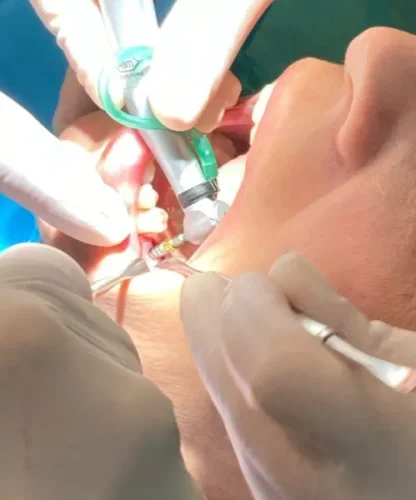 Implantología Cádiz 2 - Clínica Integral