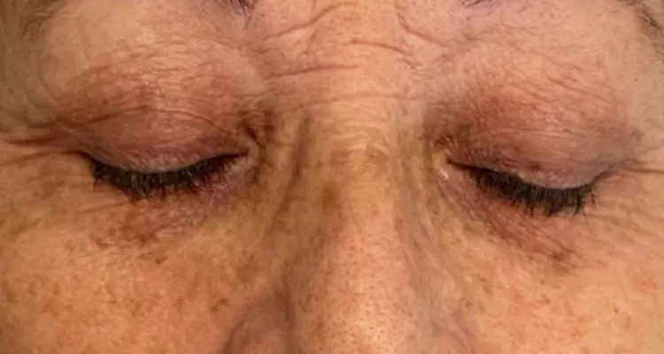 Periocular antes y despues 1