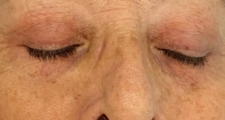 Periocular antes y despues 2