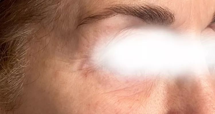 Periocular antes y despues 3