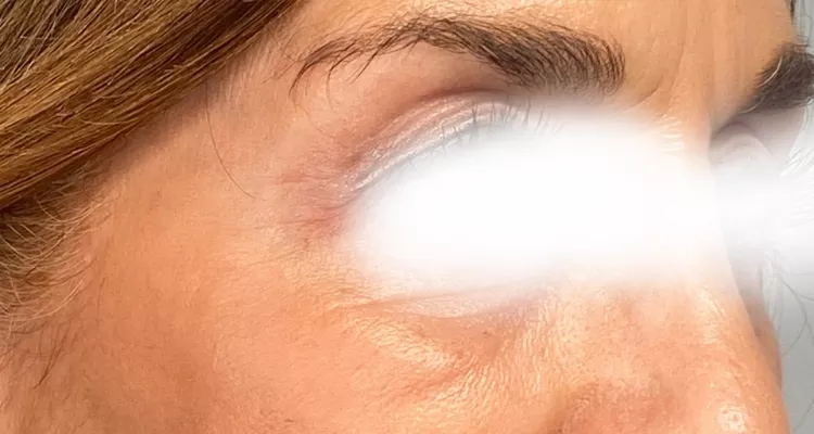 Periocular antes y despues 4