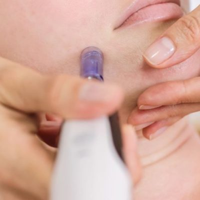 Dermapen: rejuvenece tu piel de forma natural