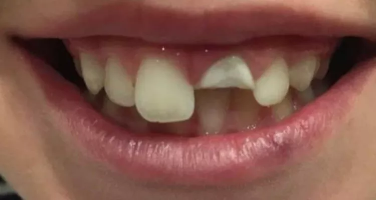 Reconstruccion De Incisivo Fracturado 1 Clinica Integral