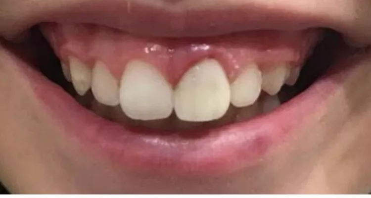 Reconstruccion De Incisivo Fracturado 2 Clinica Integral