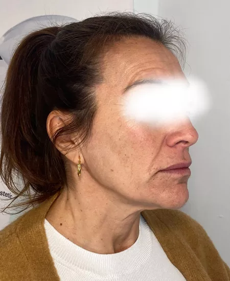 Rejuvecimiento No Invasivo 1 Clinica Integral Rejuvecimiento No Invasivo 1 Clinica Integral