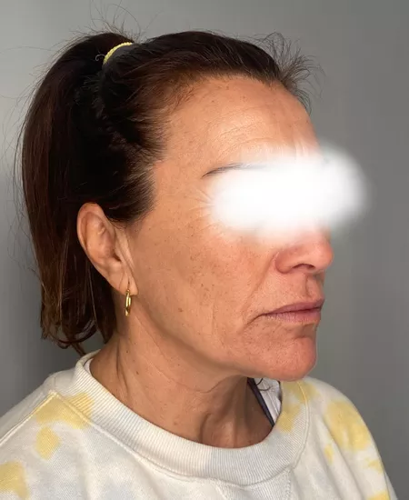 Rejuvecimiento No Invasivo 2 Clinica Integral