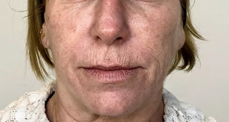 Rejuvenecimiento antes y despues 1