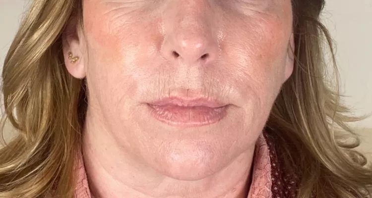 Rejuvenecimiento antes y despues 2