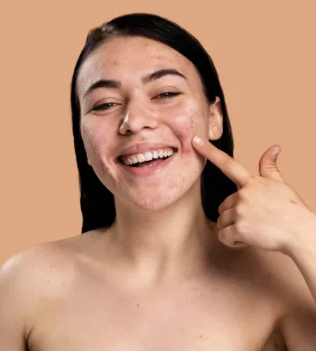 Eliminar marcas de acné