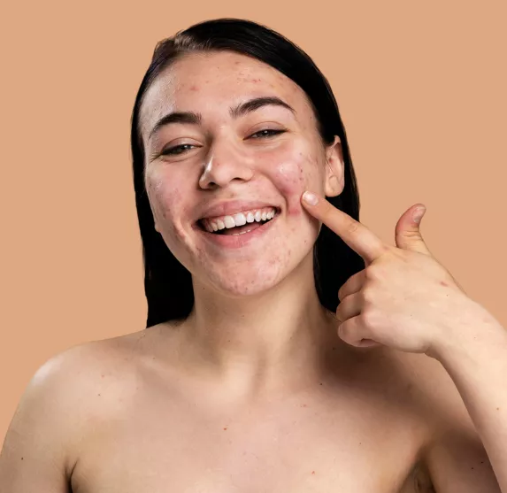 Tratamiento Eliminar marcas de acné - Clínica Integral