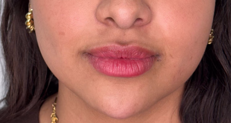 Bichectomia Despues Sin Fondo Clinica Integral Bichectomia Despues Sin Fondo Clinica Integral