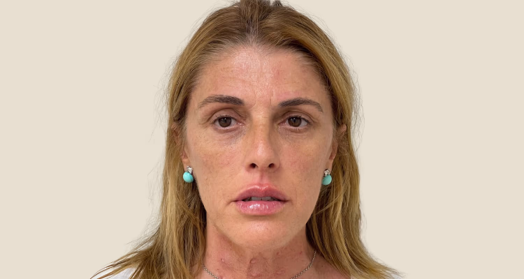 Bioestimuladores Despues Sin Fondo Clinica Integral