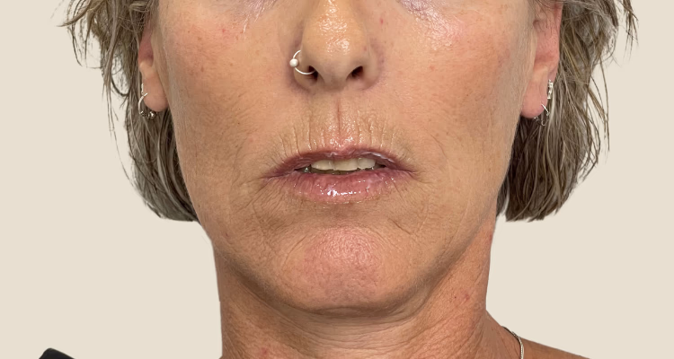 Linea De Marioneta Antes Sin Fondo Clinica Integral