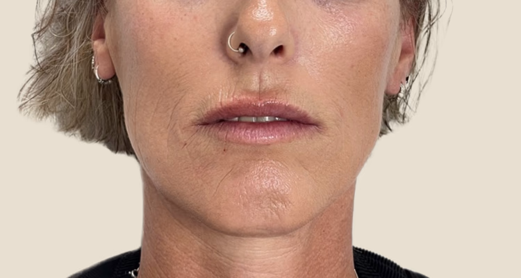 Linea De Marioneta Despues Sin Fondo Clinica Integral