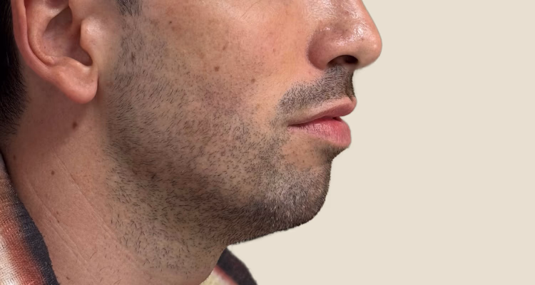 Marcacion Mandibular Antes 2 Sin Fondo Clinica Integral