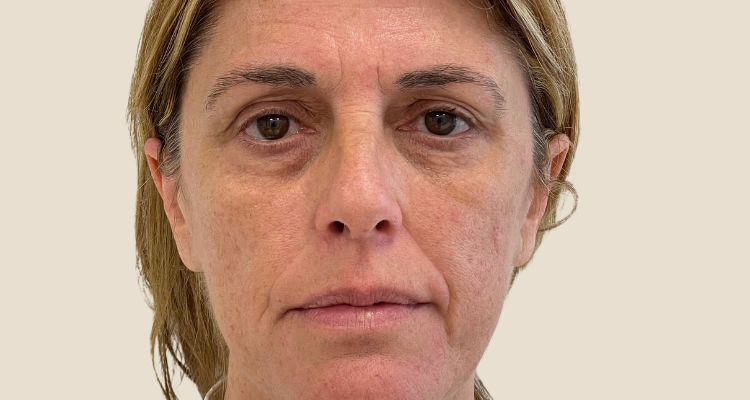 Relleno De Ojeras Antes 1 Sin Fondo Clinica Integral