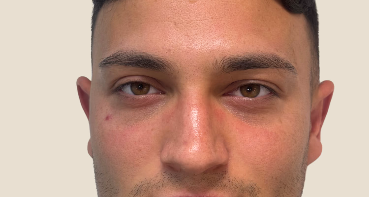 Relleno De Ojeras Antes 2 Sin Fondo Clinica Integral