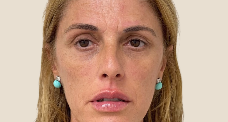 Relleno De Ojeras Despues 1 Sin Fondo Clinica Integral