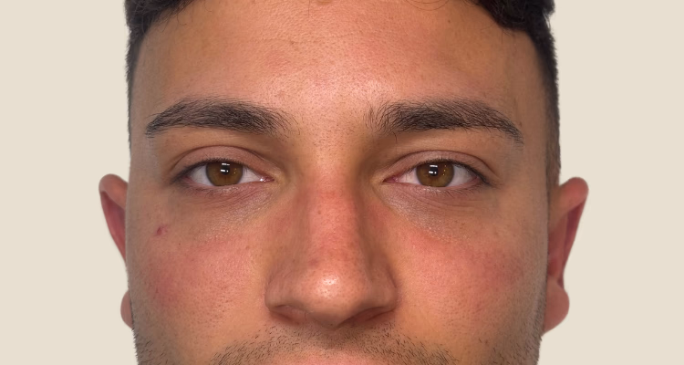 Relleno De Ojeras Despues 2 Sin Fondo Clinica Integral