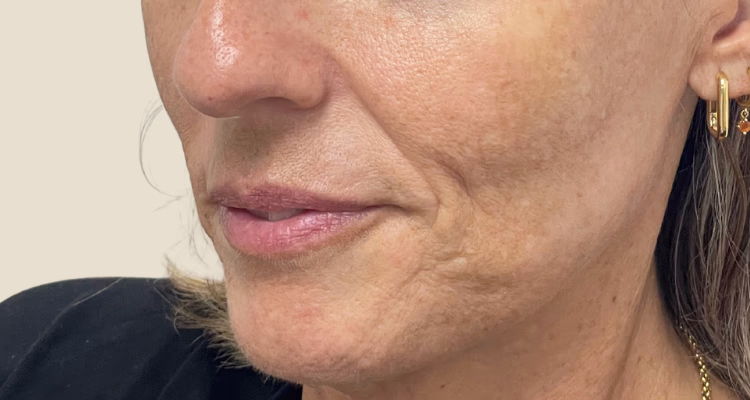 Surco Nasogeniano Antes 2 Sin Fondo Clinica Integral Surco Nasogeniano Antes 2 Sin Fondo Clinica Integral