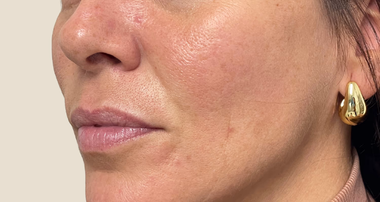 Surco Nasogeniano Antes Sin Fondo Clinica Integral Surco Nasogeniano Antes Sin Fondo Clinica Integral