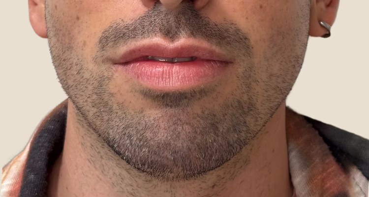 Marcacion Mandibular Antes 2 Clinica Integral