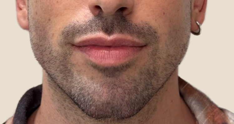 Marcacion Mandibular Despues 2 Clinica Integral