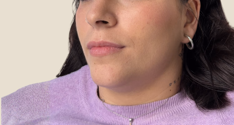 Relleno De Labios Antes 2 Clinica Integral Relleno De Labios Antes 2 Clinica Integral