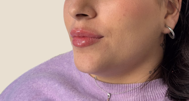 Relleno De Labios Despues 2 Clinica Integral
