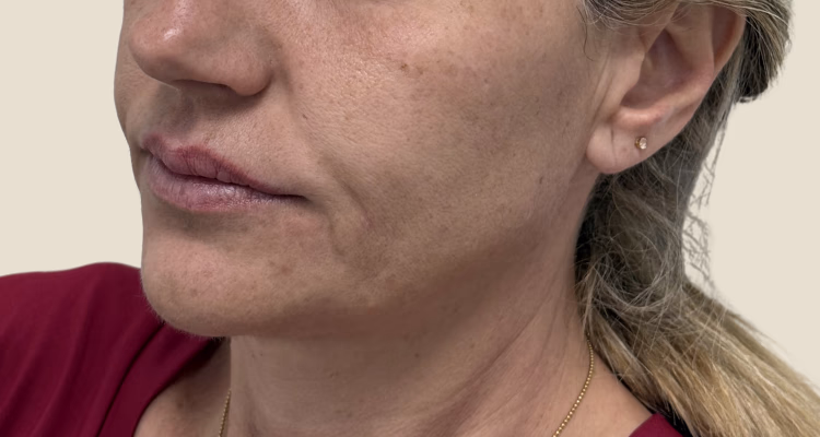 Relleno De Pomulos Antes 1 2 Clinica Integral Relleno De Pomulos Antes 1 2 Clinica Integral