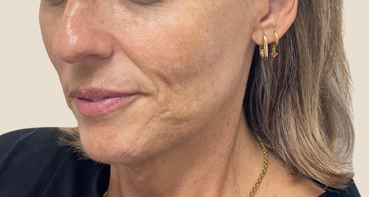 Relleno De Pomulos Antes 2 2 Clinica Integral Relleno De Pomulos Antes 2 2 Clinica Integral