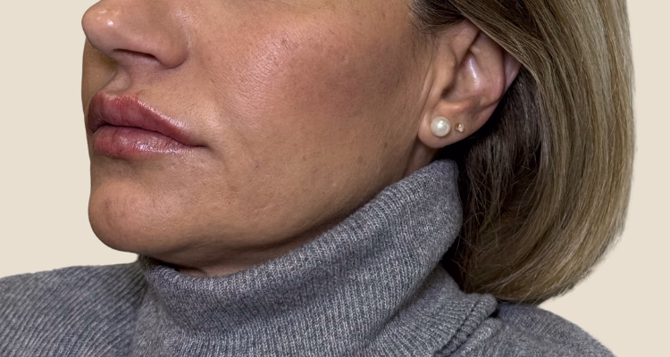 Relleno De Pomulos Despues 1 2 Clinica Integral