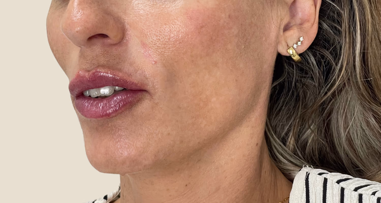 Relleno De Pomulos Despues 2 2 Clinica Integral