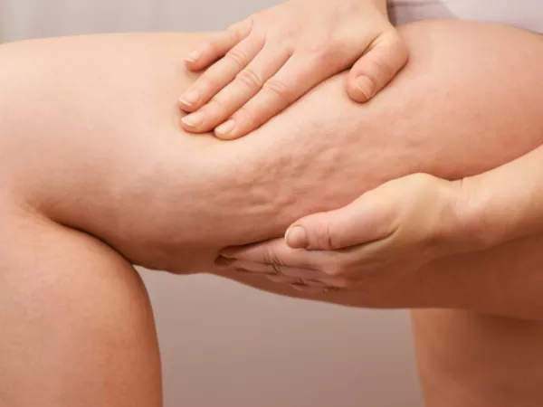Celulitis piernas - Clinica Integral