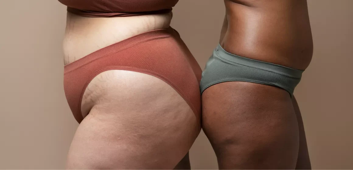 Flacidez y celulitis en piernas: cómo entender tu cuerpo y mejorar su aspecto