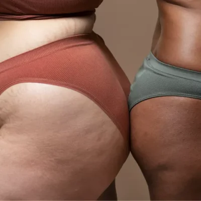 Flacidez y celulitis en piernas: cómo entender tu cuerpo y mejorar su aspecto