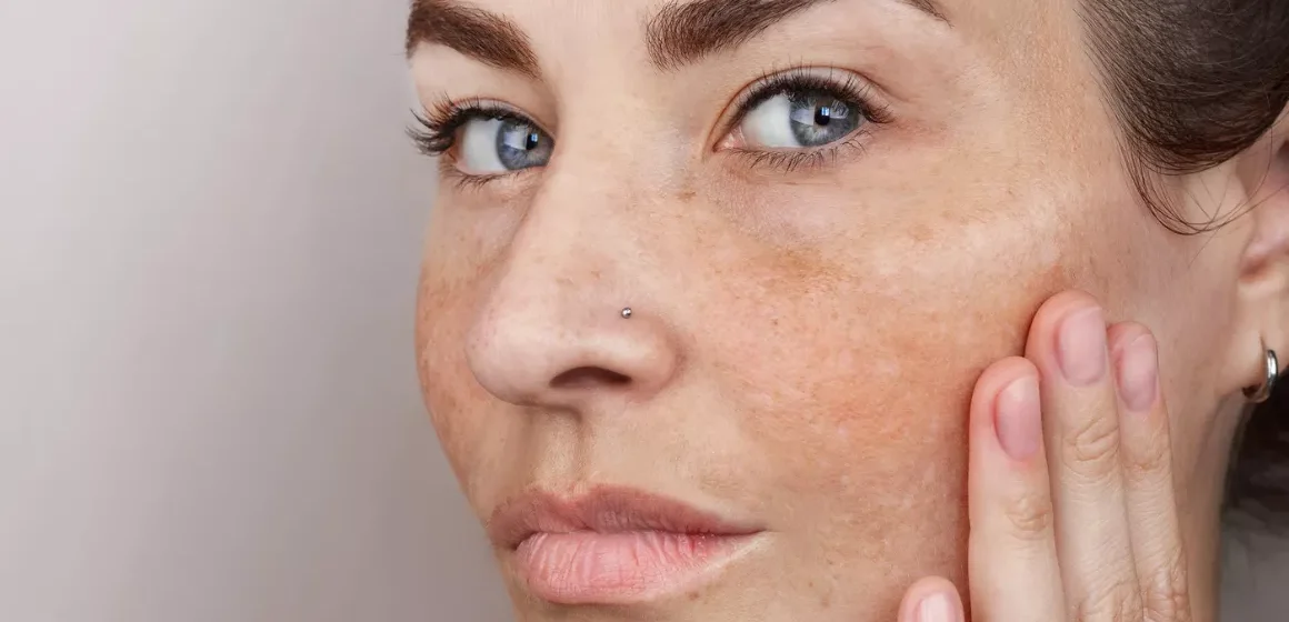 Despigmentación en la piel: causas y cómo mejorarla