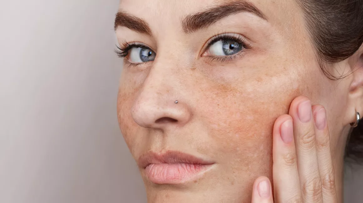 Despigmentación en la piel - Clínica Integral