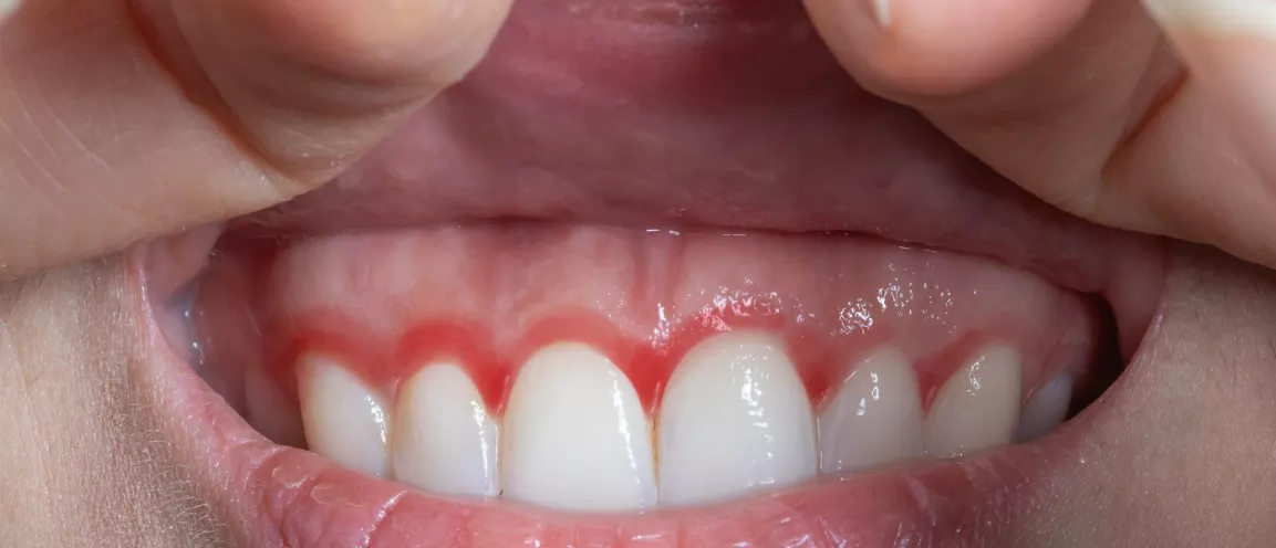 La gingivitis es contagiosa - Clinica Integral