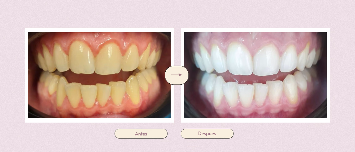 Caso real- tratamiento de encías y blanqueamiento dental en 4 semanas - Clinica Integral